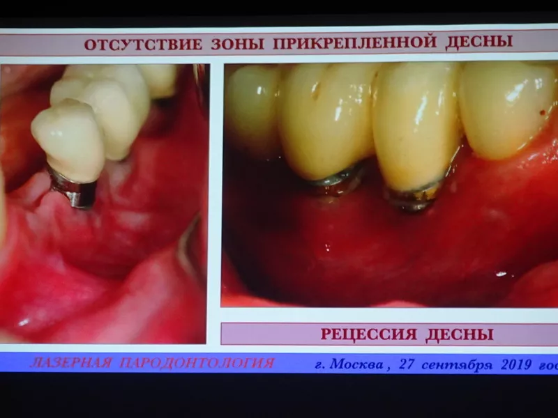 Решение проблем с отсутствием прикрепленной десны. Лазер ПИКАССО