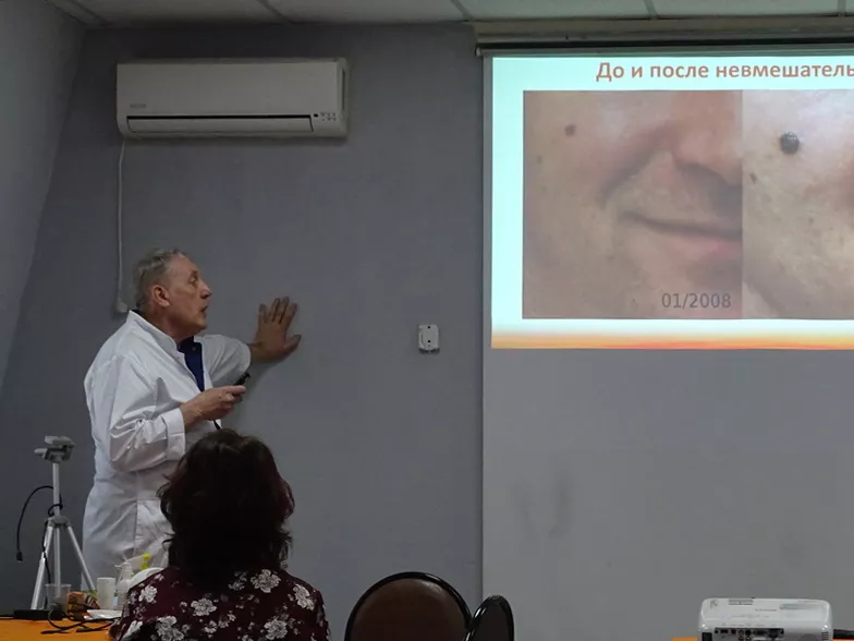 Результат удаление диодным лазером Пикассо
